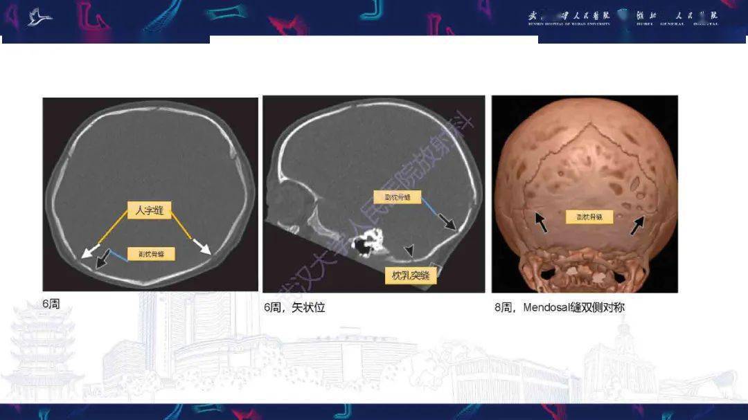 儿童颅骨骨折ct诊断