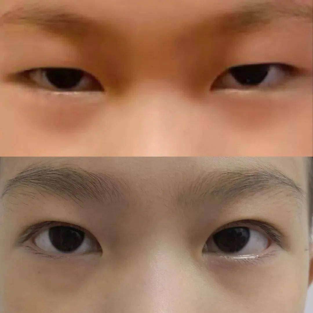 上睑睫毛倒睫手术前后对比下睑睫毛倒睫手术前后对比成妇儿眼科已经为