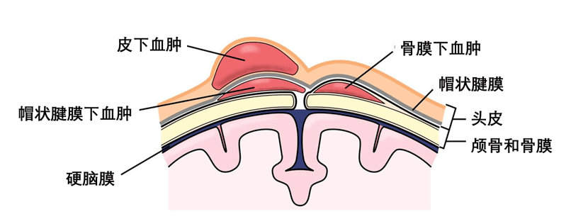 根据血肿的范围分为皮下血肿,帽状腱膜下血肿和骨膜下血肿三大类