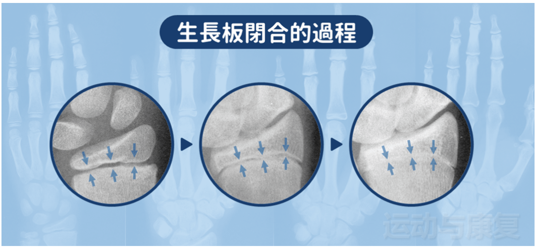 骺板间隙图片