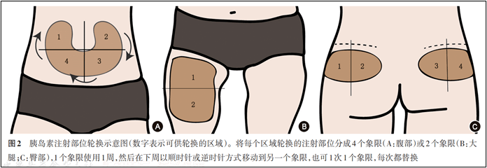 肚子鼓了个"包"——胰岛素注射相关皮下脂肪增生_血糖_部位_诊断