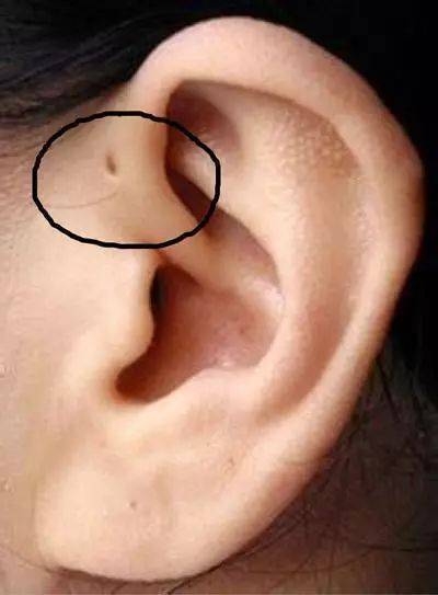 耳仓手术图解图片
