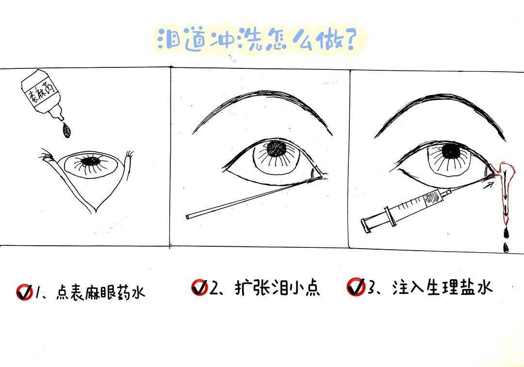 结膜囊冲洗ppt图片