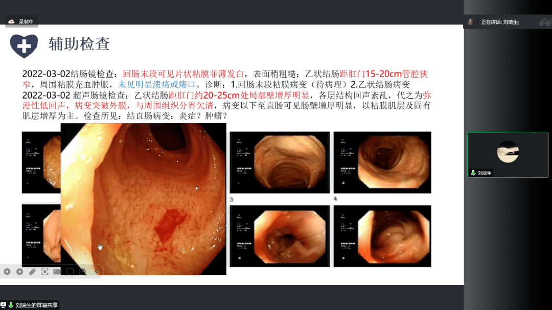 乙状结肠炎症图片