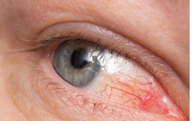 眼睛有明显瘙痒感以及充血,常常伴有白色分泌物