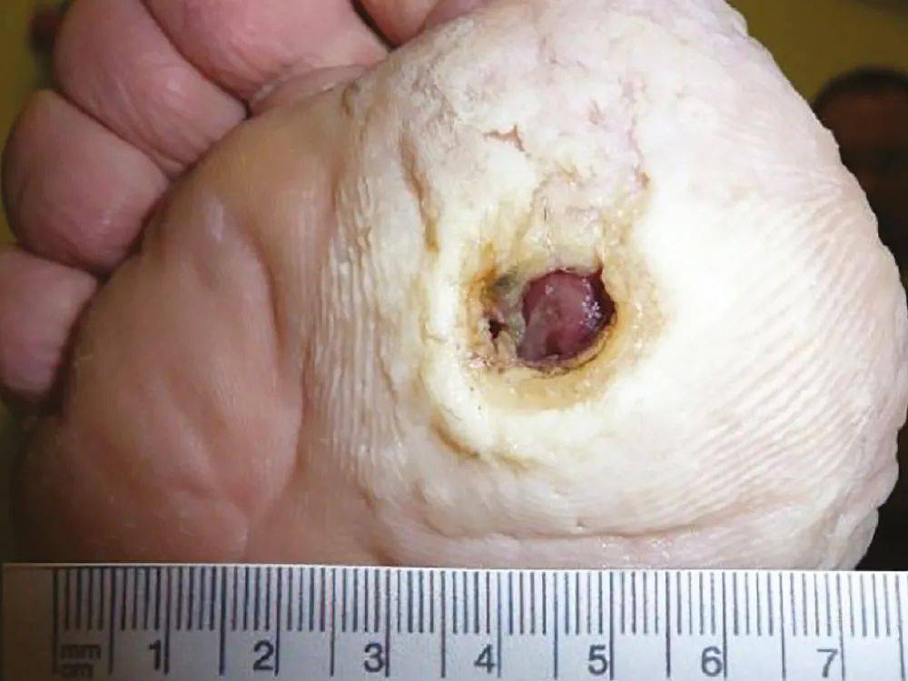 伤口浸渍:识别,管理和预防_皮肤_敷料_护理