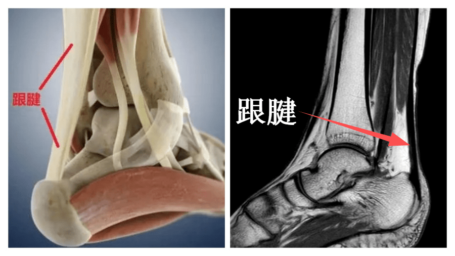 沃尔跟腱图片