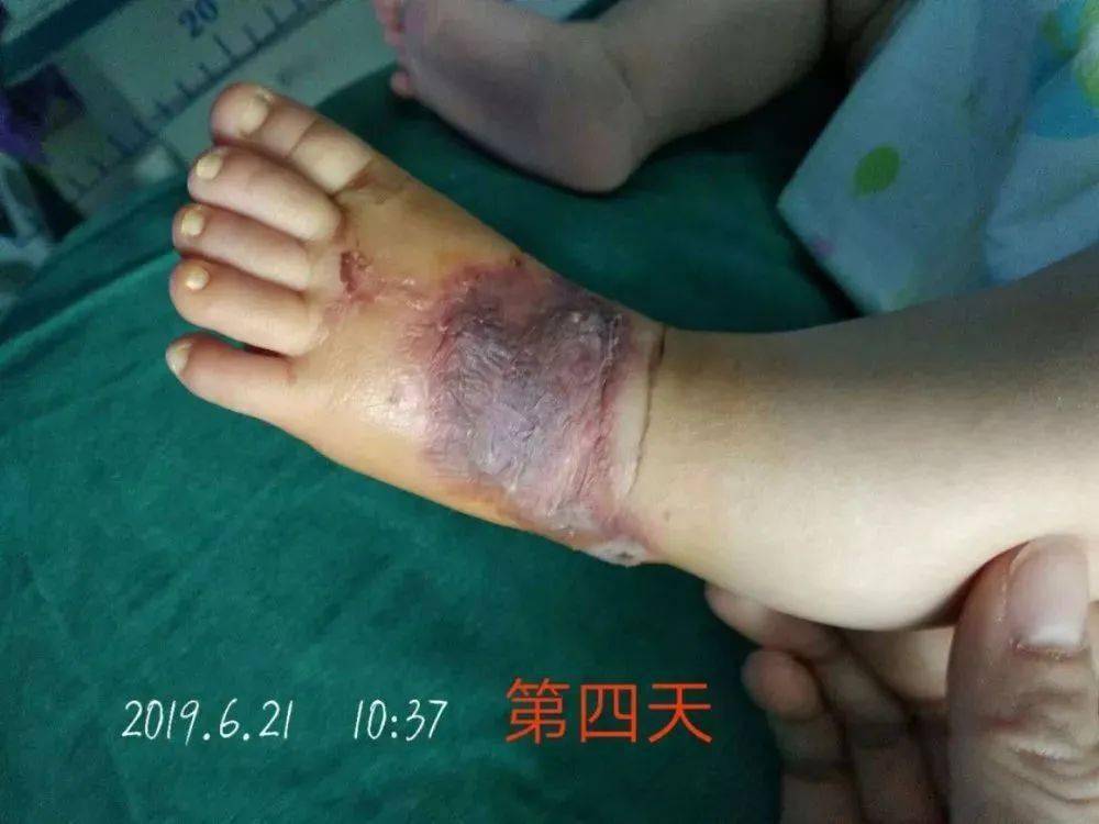 触目惊心!一例新生儿输液渗漏的案例讨论