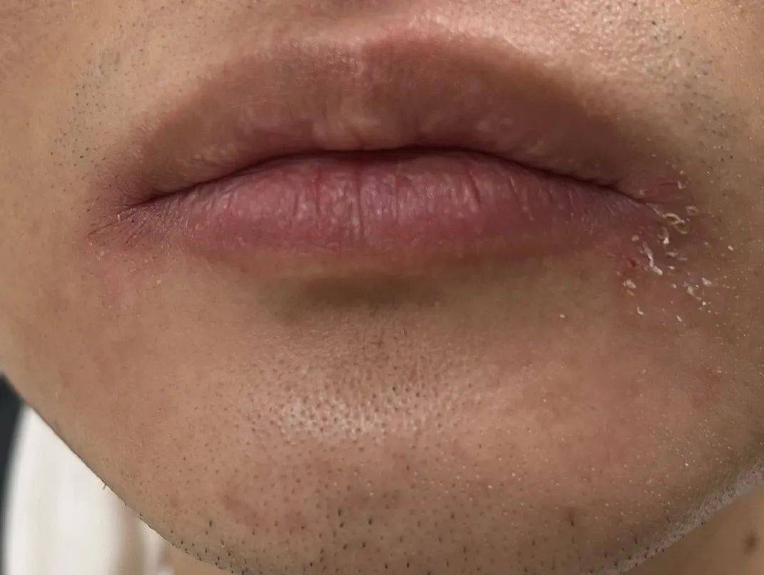牙膏中的氟化物,防腐剂,香精,表面活性剂等物质可能会引起嘴唇过敏