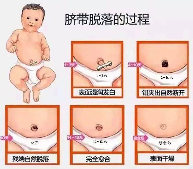 婴儿脐带有脓怎么处理图片