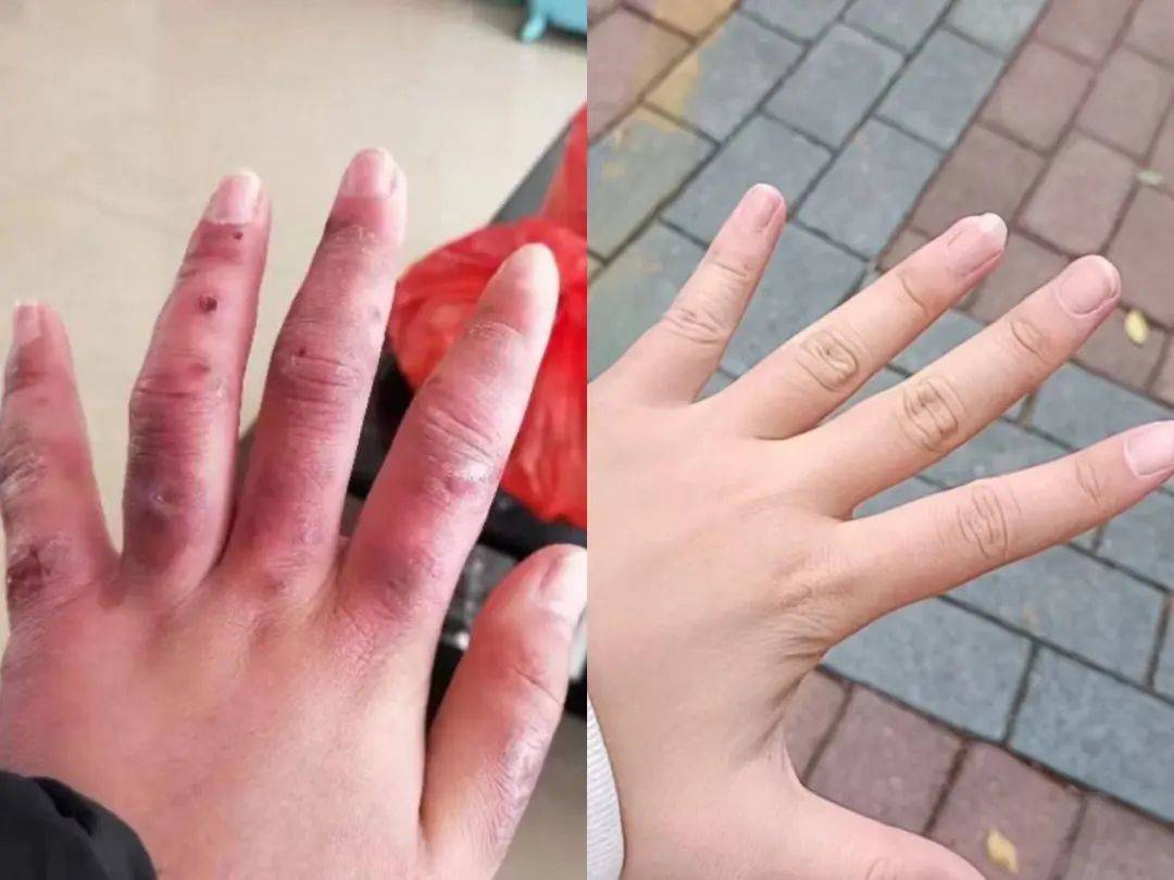 火出圈改善冻伤的方法真的有用吗?