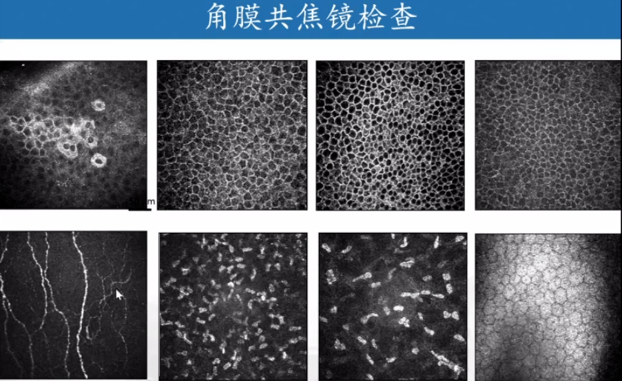 角膜共聚焦显微镜检查 | 告诉你"角膜炎"究竟是什么"炎症"?
