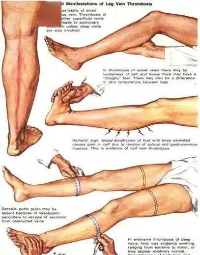 homans征c 混合型:血栓弥漫于整条患肢深静脉系统,表现为患肢明显肿胀