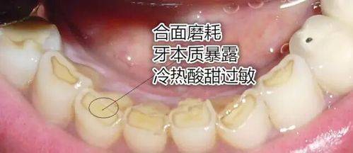 补牙七颗,整理分享口腔护理危害误区!_牙齿_问题_进行