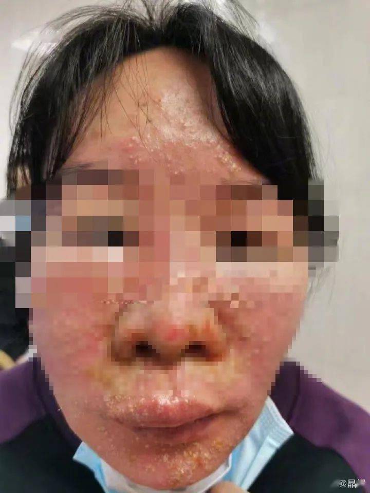 经医生分析,系因感染新冠病毒后过量饮水导致水中毒引起.