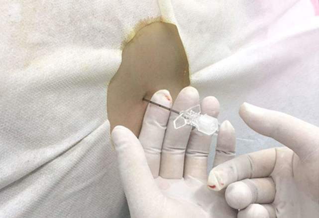 麻醉用针硬膜外穿刺针怎样的针才是合格的麻醉针?_检测_的要求_针尖