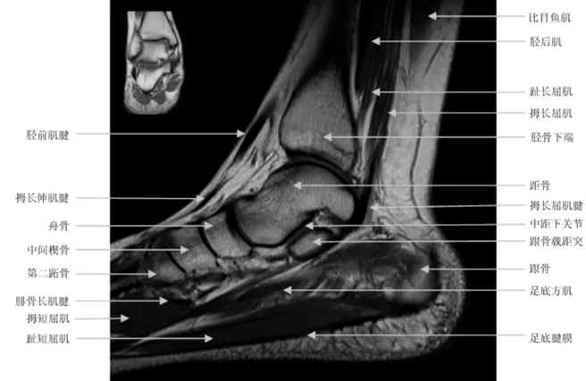 脚部结构脚后跟图片