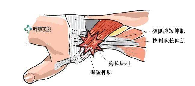 "妈妈手"相关解剖,评估,筋膜分析_肌腱_交叉_综合征