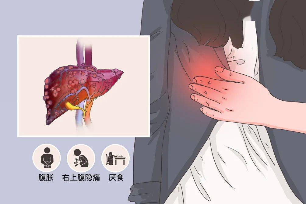 【健康医声】长满"水泡"的肝脏---多囊肝_治疗_超声_患者