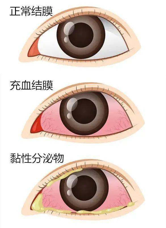 (结膜炎)眼睛发红(赤),眼屎多,常常是相连的症候.