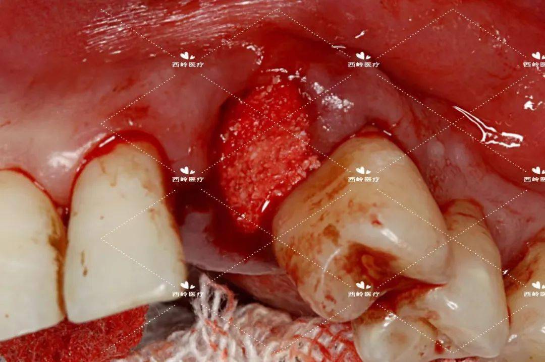 拔牙后长红色肉芽图片图片