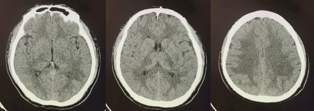 【病例分享】椎管內自發性腦脊液漏致反覆硬膜下血腫復發一例(第二輪