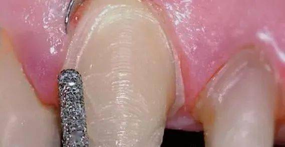 排龈线的选择,及排龈方式的设计_进行_预备_备牙