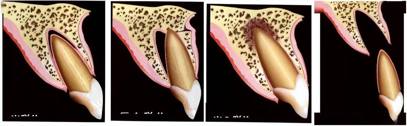 牙脱位表现为牙齿脱离牙槽窝,可伴随疼痛,出血,牙龈撕裂,咬合干扰等
