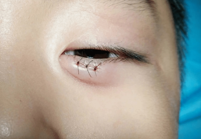 假期到来,家长必备:儿童眼外伤的正确处理方式_眼球_伤口_孩子