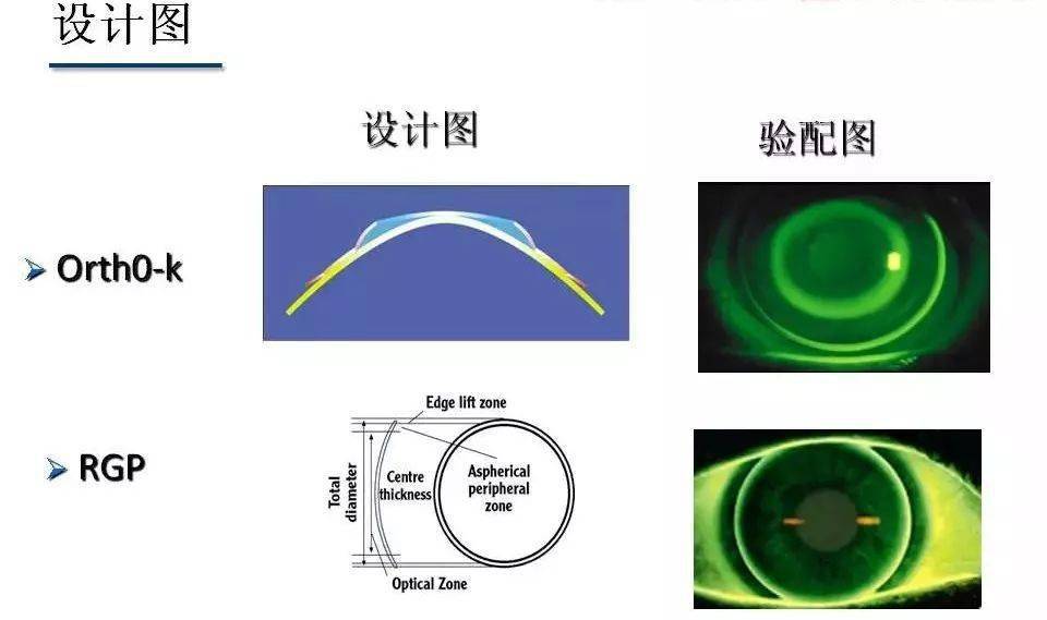 角膜塑形镜松紧配时图图片