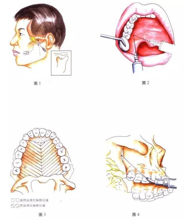 再将注射器移至患侧,仔细探入翼腭管,此时注射针与上颌成45°,向上向