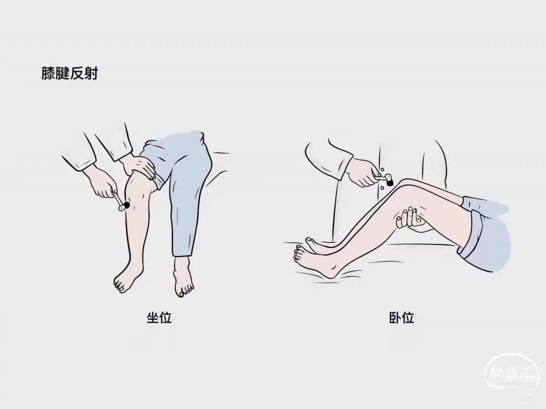 【图文】漫话叩诊锤和腱反射检查技巧_诊断_定位_临床