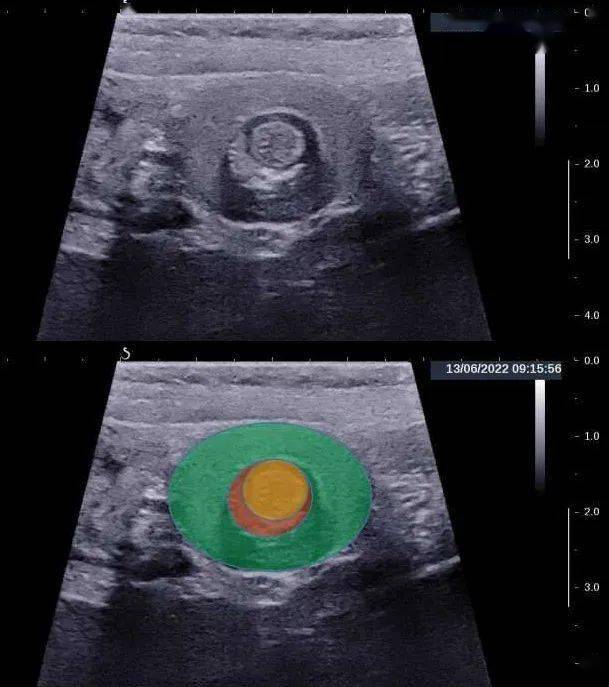 超声征象61面包圈内新月征_肠管_回声_外层