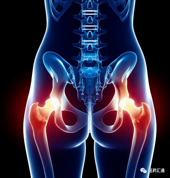 肌肉,骨骼,神经,这4种常见的臀部疼痛应该如何区分?