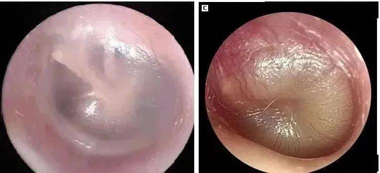 【迁医健康】你以为的中耳炎可能并非如此简单