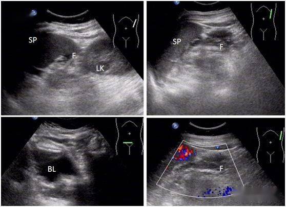 超声遇到 1 例诡异的左上腹痛,差点掉坑里!