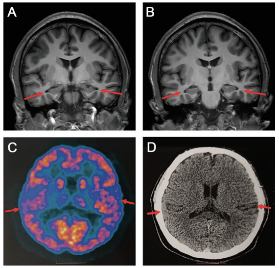 影像学检查:患者脑 mri 显示双侧海马体轻度萎缩,脑沟和脑裂轻度增宽.