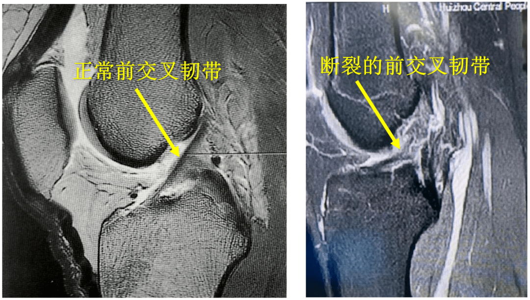 【聚焦临床】踢足球扭伤导致韧带断裂!关节和运动医学外科专家提醒:警惕前交叉韧带损伤_手术_患者_治疗