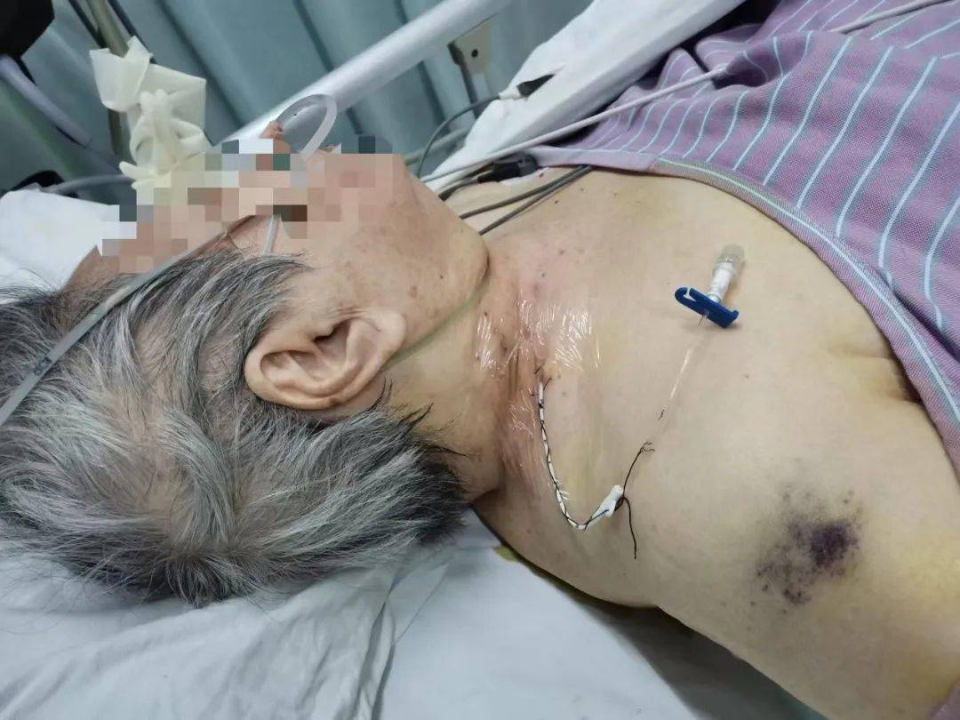 看到即得到之超声引导侧卧位斜轴颈内静脉穿刺置管_患者_临床_技术