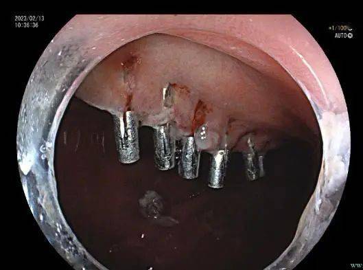 内镜ESD黄金刀图片