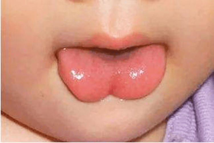 【科普那些事儿】丨宝宝口齿不清,大舌头,是因为舌系带过短吗?