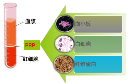 膝關節炎患者的福音——膝關節腔富血小板血漿微創治療技術(prp)_骨科