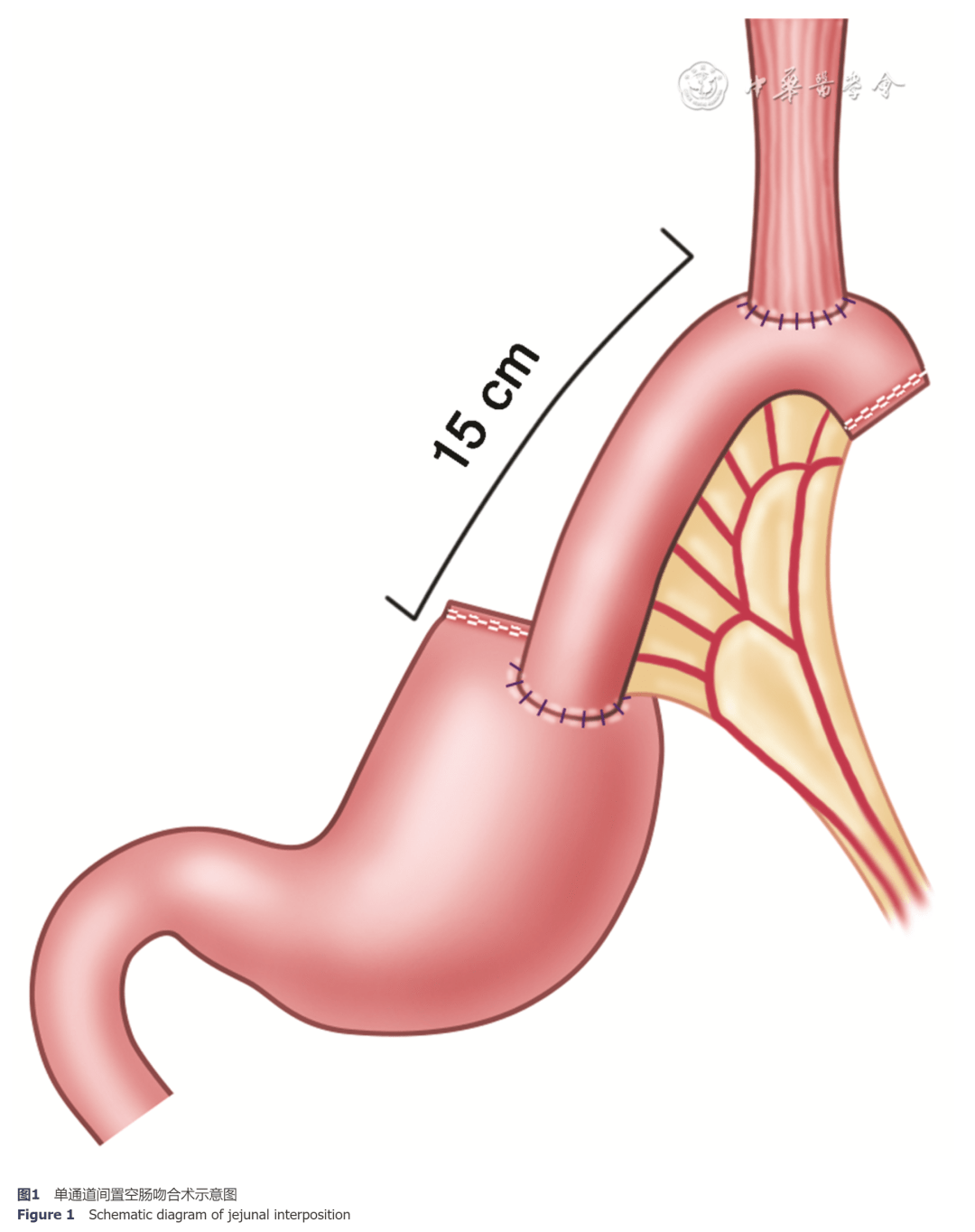 袖状胃空肠旷置手术图片