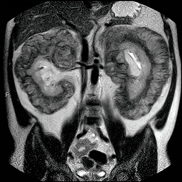 ��ë������������ʶErdheim-Chester ��