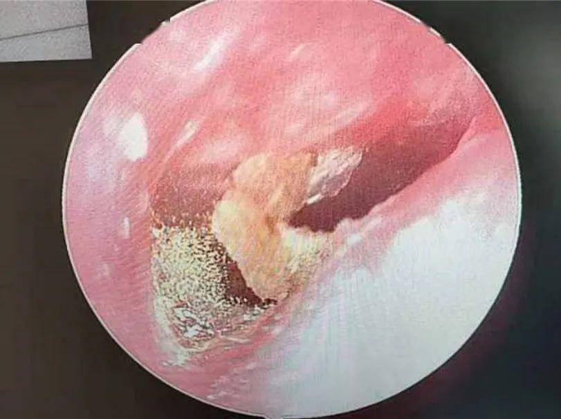 外耳道_女士_耳屎