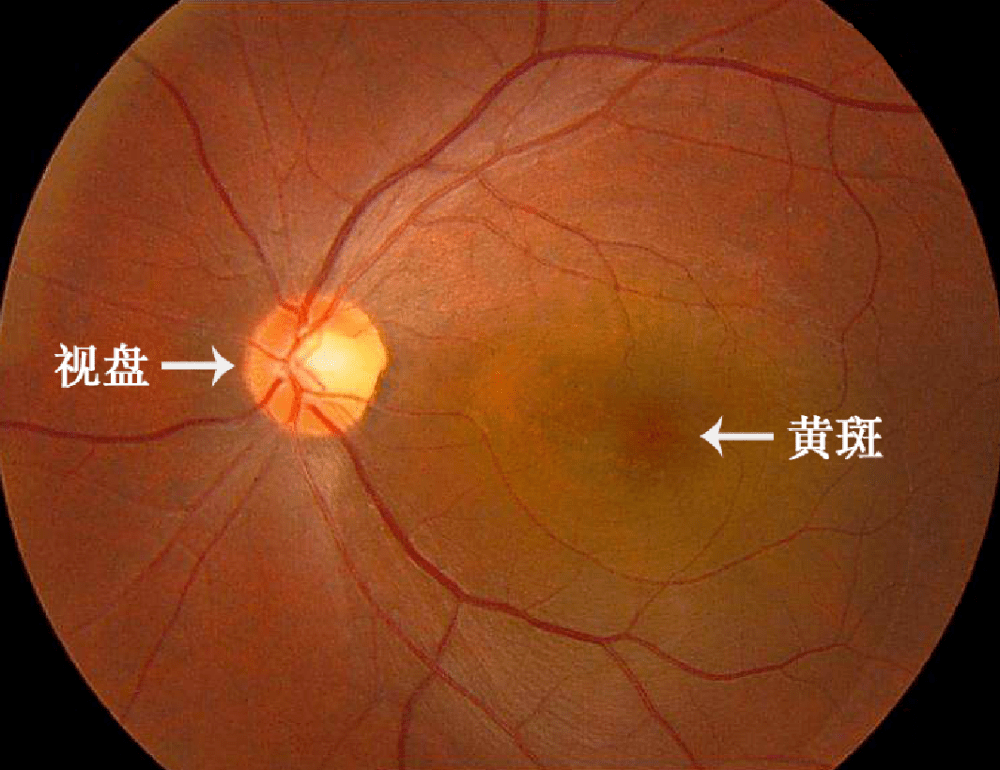 什么样的斑叫黄斑?