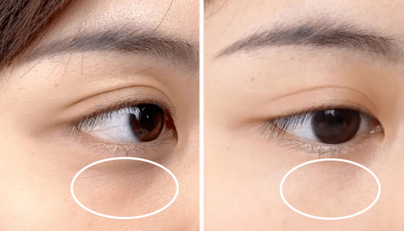 官方宣称使用4周眼下细纹就能有效减淡近15%,8周可以淡化27%
