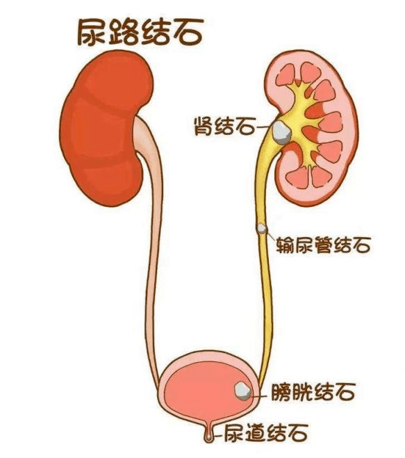 肾结石痛起来真要命!哪些药物可以治疗和预防?_尿液_草酸_食物