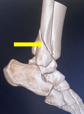 踝关节骨折ct图片图片