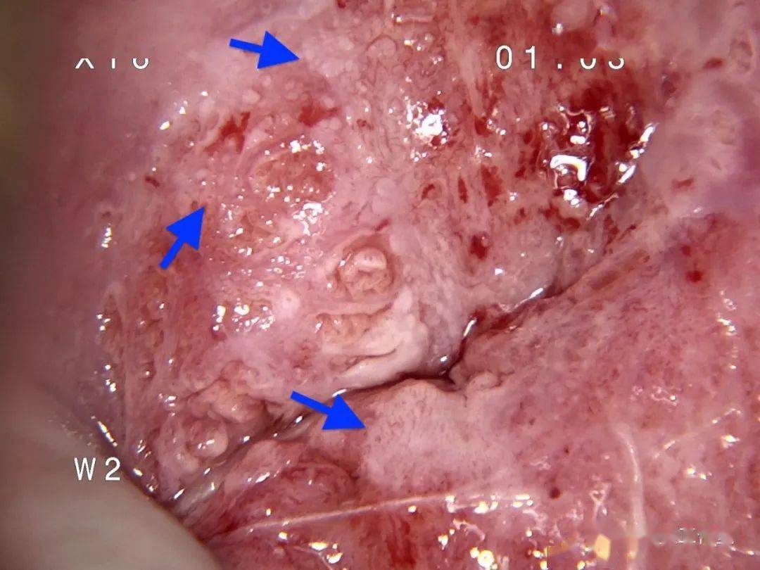 宫颈为1型转化区,可见醋酸白色上皮,点状血管,镶嵌和白色腺体,碘试验